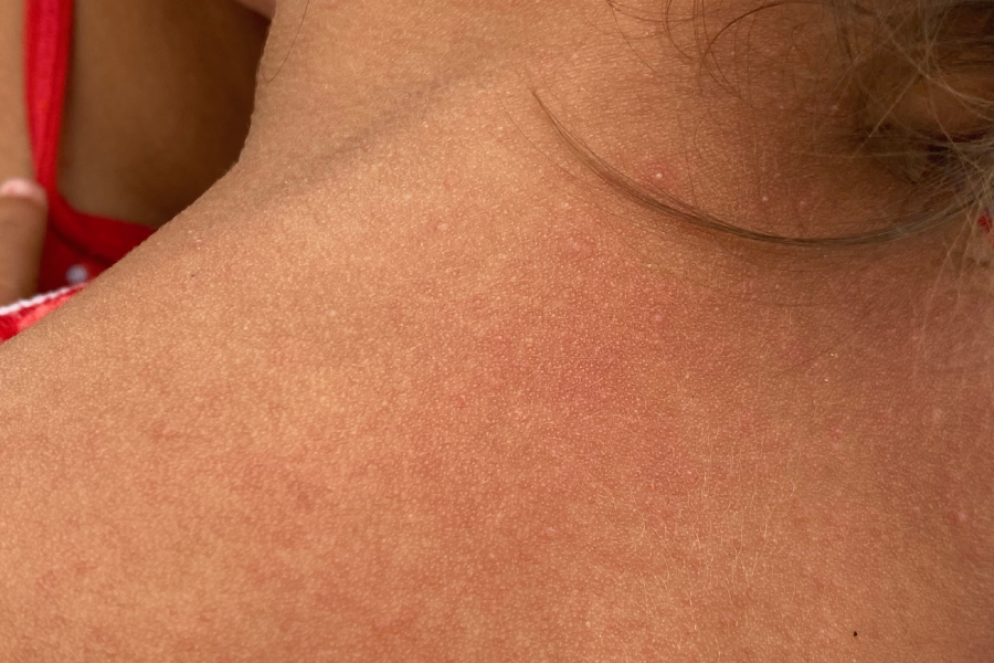 A pequena Arlinys exibe o pescoço e a testa com pequenas bolhas vermelhas. “É alergia do calor!”, explica a mãe Maria Martinez, com o limitado português. Foto: Felipe Medeiros/Amazônia Latitude.